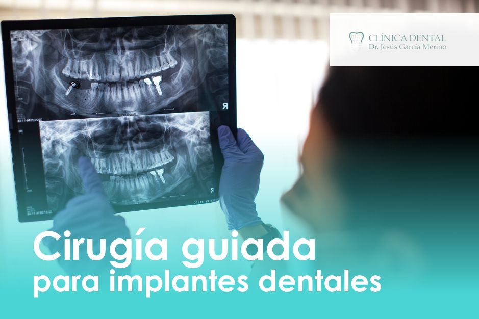 Cirugía guiada para implantes dentales en Jaén clinica dental implantologia