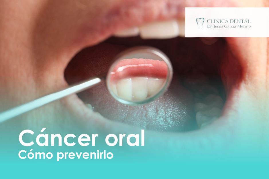 cancer oral como prevenirlo Clinica Dental Jaén revision gratuita