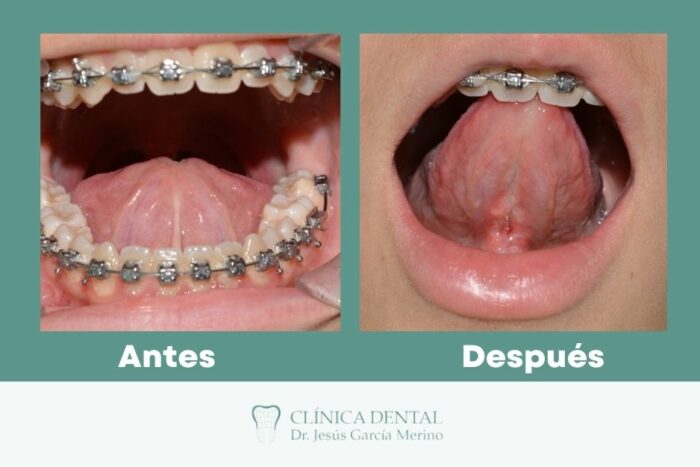 Frenillo bucal clinica dental jaen 