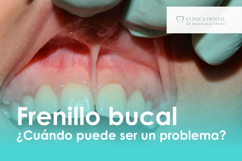 Frenillo bucal clinica dental jaen