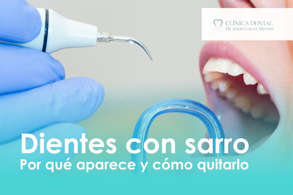 Dientes con sarro por qué aparece y cómo quitarlo clinica dental jaen jesus garcia merino dentista