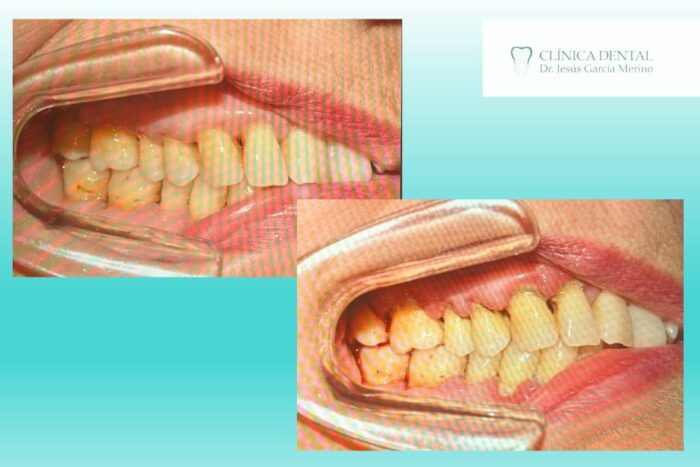 dientes con sarro dentista jaen clinica dental