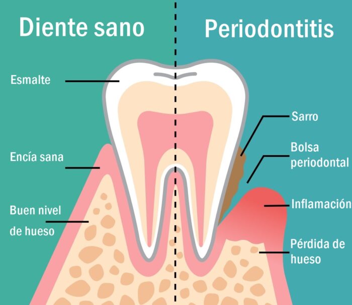 Diente-sano-periodontitis-tratamiento-jaen-clinica-dental-dentista