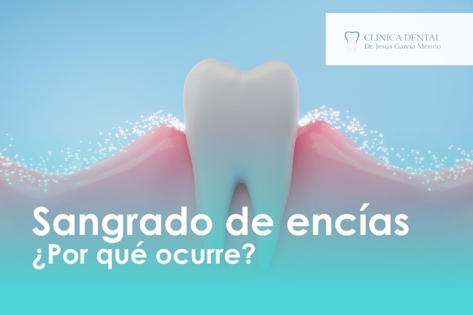 Por qué me sangran las encías dentista jaen dr jesus garcia merino clinica dental